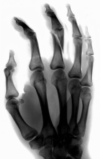 1-hand