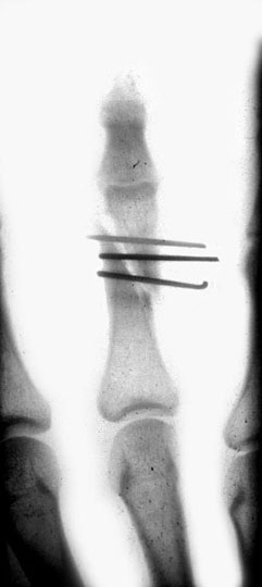 2-pins